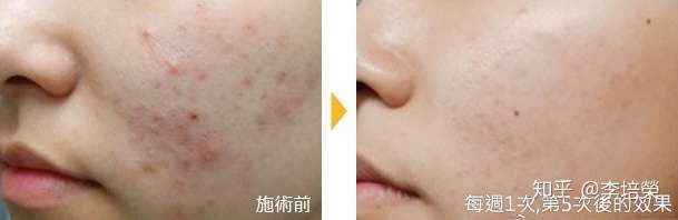為什麼up雷射可以治療凹痘疤 有副作用嗎