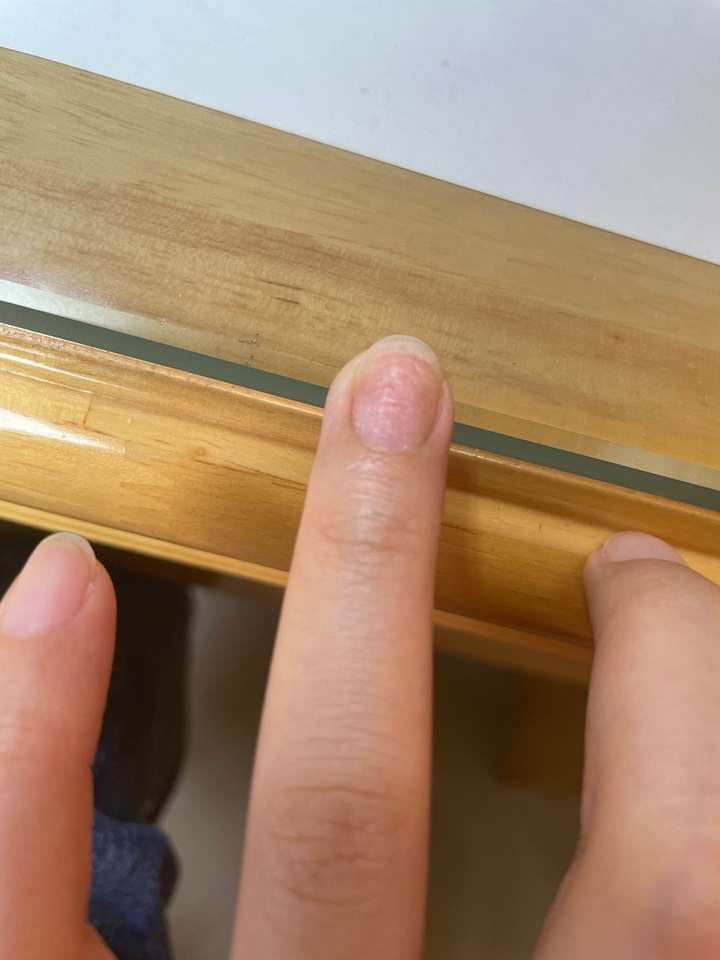 大拇指指甲凹凸不平,有凸起的横纹和凹陷,很多年了也没有其它问题,去