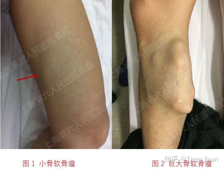 胳膊和腿上突出的硬块是什么 骨软骨瘤的症状与治疗 知乎