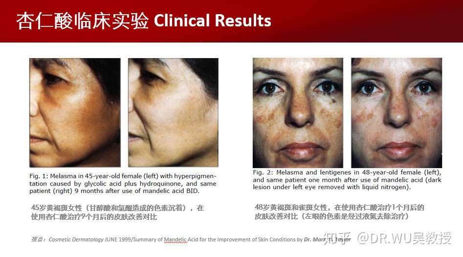 如何正确刷酸 皮肤科医生教你果酸焕肤不烂脸 知乎 如何正确刷酸 皮肤科医生教你果酸焕肤不烂脸 知乎