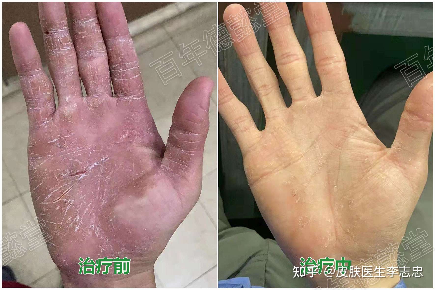 皮肤医生李志忠 的想法: 皲裂性湿疹,主要表现为浸润,肥厚,干燥