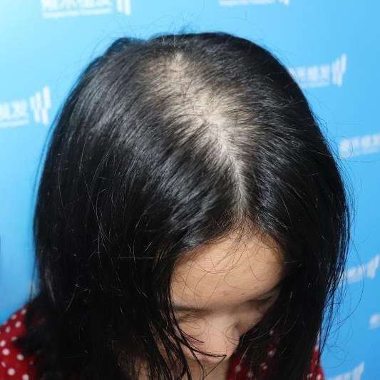 刘女士脱发症状主要表现为头顶发缝向两侧蔓延,呈弥漫性稀疏.