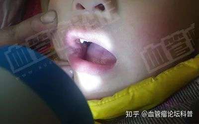 婴儿嘴角和口腔内血管瘤及早治疗早康复