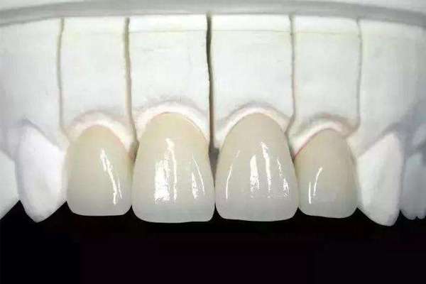 二氧化锆全瓷牙的寿命是多少二氧化锆全瓷牙可以用多久