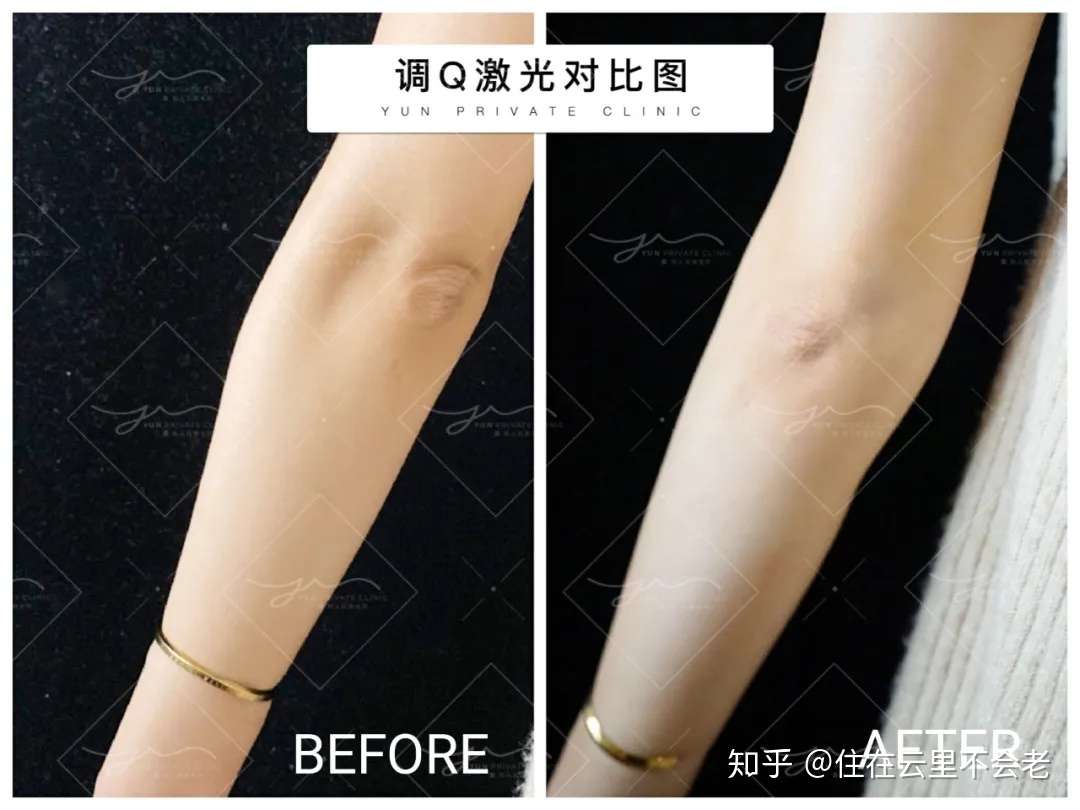 黑胳膊肘和黑膝盖 应该如何改呢 知乎