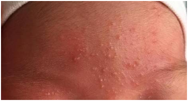 婴儿捂热的疹子怎么治疗 ( 婴儿捂热的疹子图片)