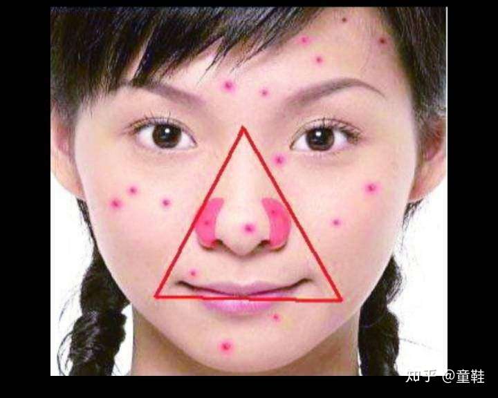 如何科学挤痘 这一篇告诉你答案 知乎