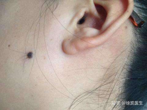 黑痣上长毛是好还是坏？需要祛除吗？