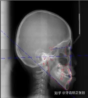 北京牙齿矫正:12岁女孩牙列拥挤骨性地包天 