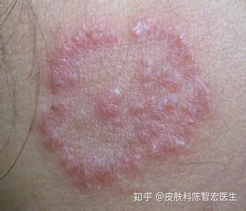 湿疹与真菌感染对照图图片