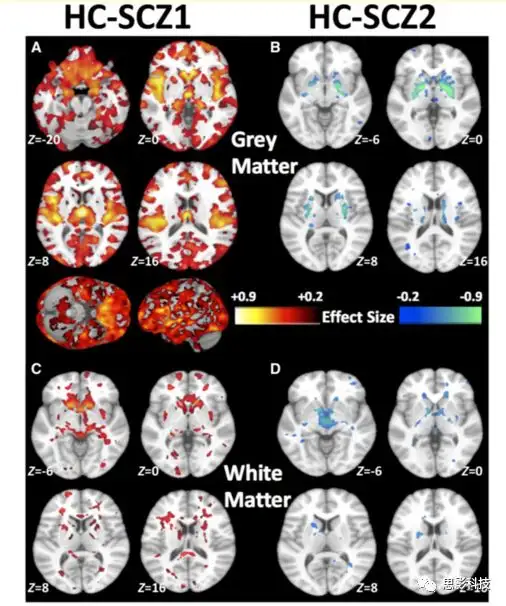 BRAIN：利用机器学习揭示了两种精神分裂症的神经解剖学亚型- 知乎