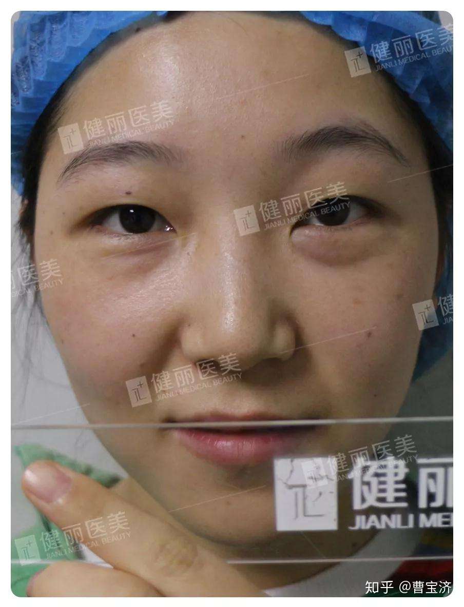 眼袋一大一小怎么办 该如何去除 知乎