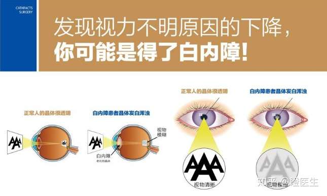 越迟越好 教您快速了解白内障手术时机 知乎