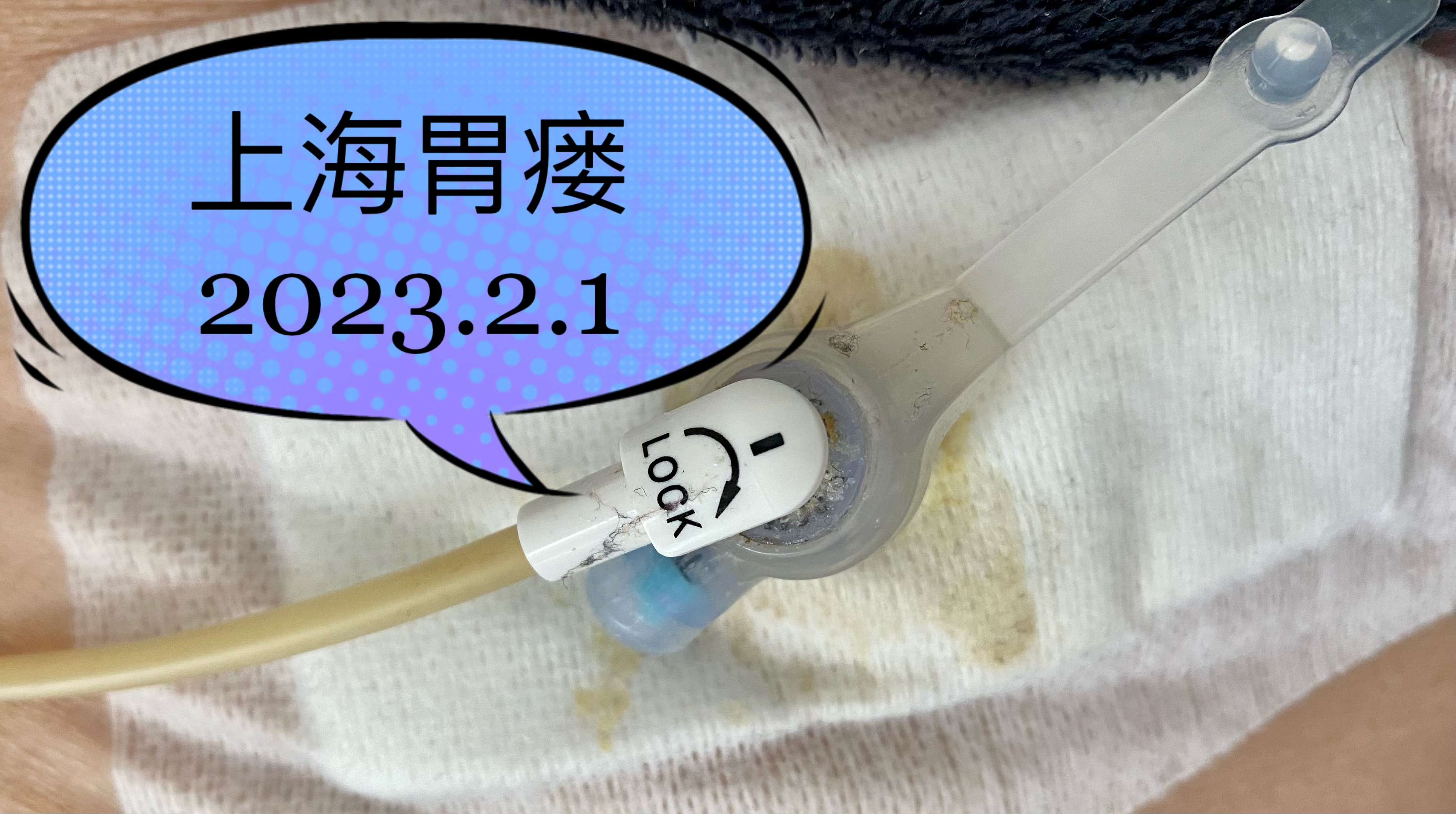 上海胃瘘 的想法: 纽扣管胃造瘘(pfg)术后12天,营养跟上… - 知乎