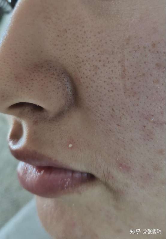 有没有收缩毛孔的好方法?