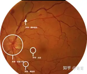 如何看懂眼底圖片