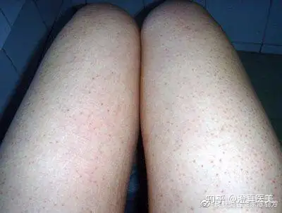 雞皮膚剋星美提塑熱水光