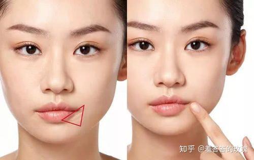22岁女生右边脸有嘴角纹(木偶纹)是为什么?如何改善?