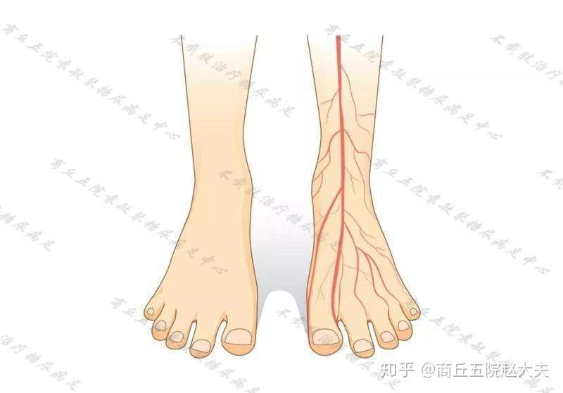 糖尿病足0级的表现是什么 知乎 糖尿病足0级的表现是什么 知乎