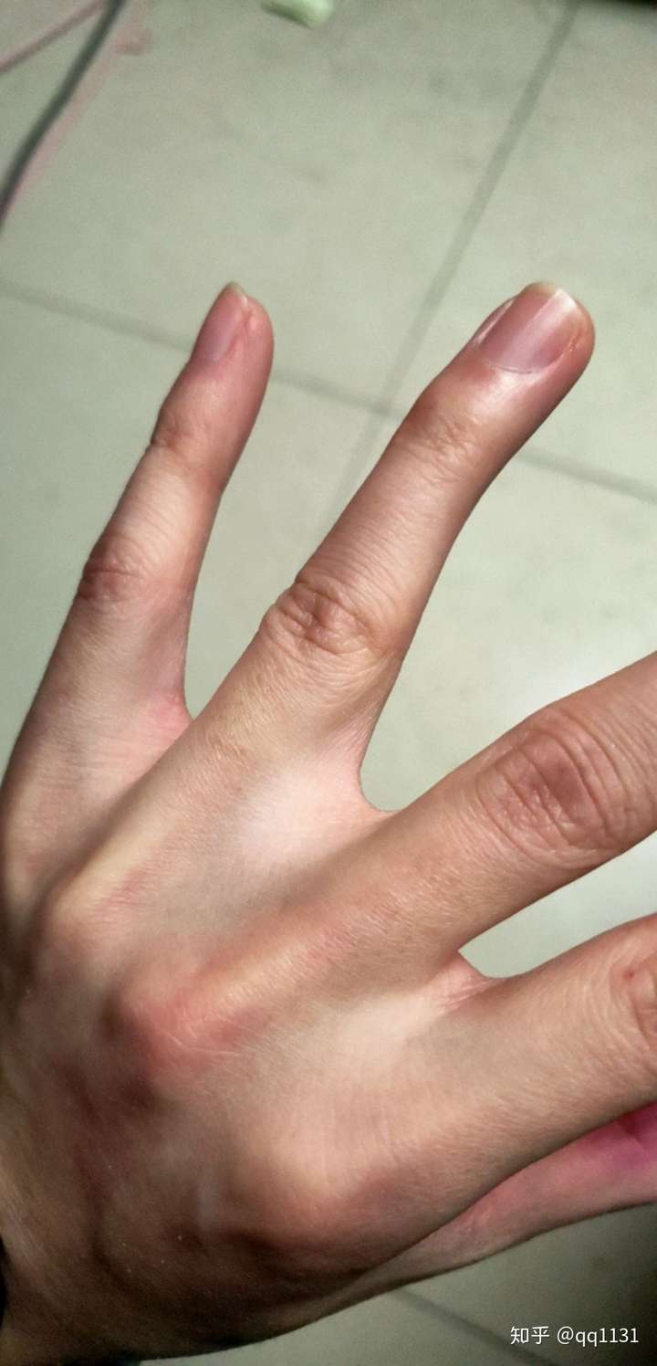 手指之间有点像蹼的东西是什么?为什么我的比别人的大许多?