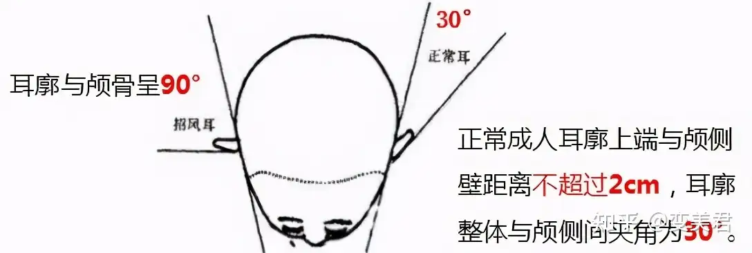 网红们开始给耳朵做整形了 精灵耳开始风靡 知乎