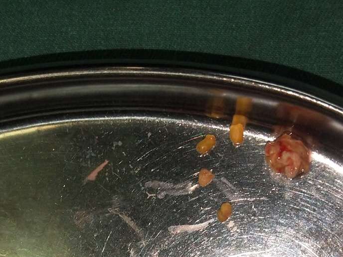 爱学鱼 的想法: 我是在305医院体检中心咨询时才知道这个… - 知乎