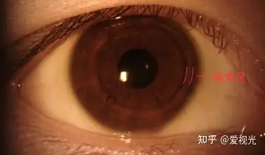 儿童近视控制的新工具多焦点接触软镜