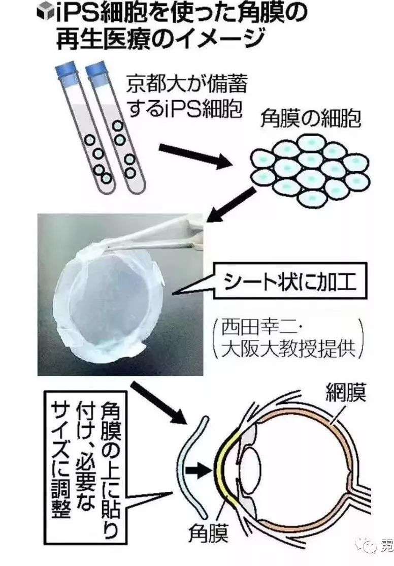 人类壮举 全球首例ips制成眼角膜移植成功 日本医疗 知乎