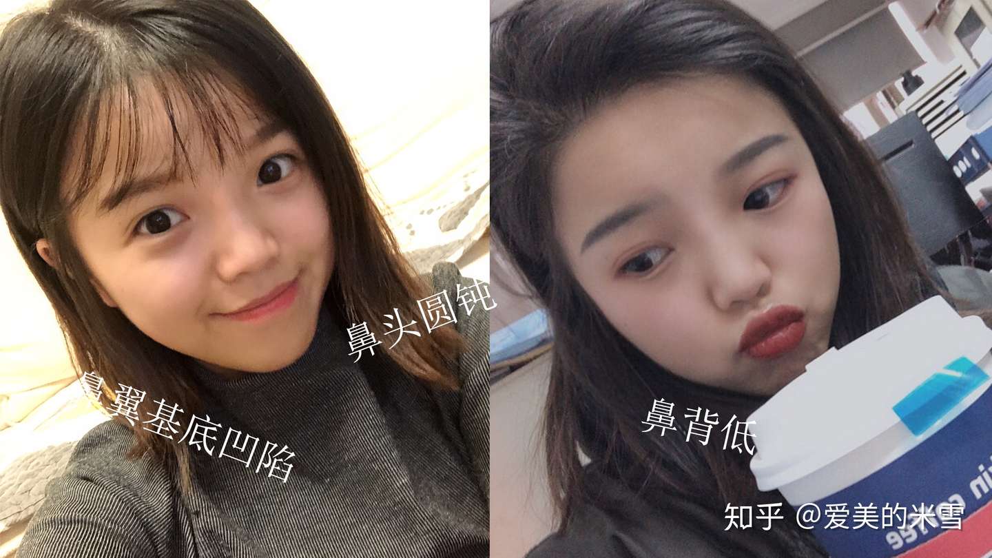 隆鼻哪里好 有推荐的吗 知乎
