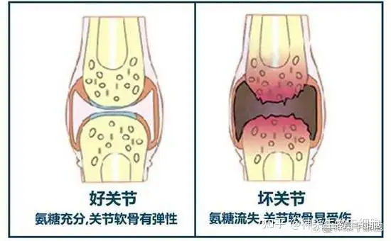 怎么修复受伤的膝盖软骨 知乎 怎么修复受伤的膝盖软骨 知乎