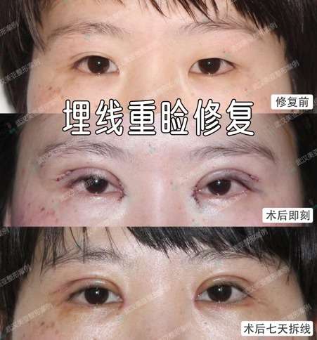 失敗 眼瞼下垂 和田アキ子の眼瞼下垂手術は失敗なのか？？？