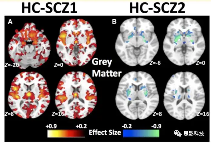 BRAIN：利用机器学习揭示了两种精神分裂症的神经解剖学亚型- 知乎