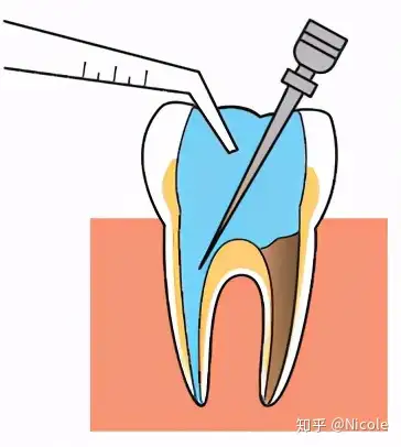 成功根管治疗的特征