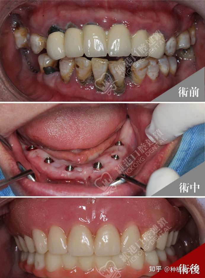 中老年人做完种植牙效果怎么样?