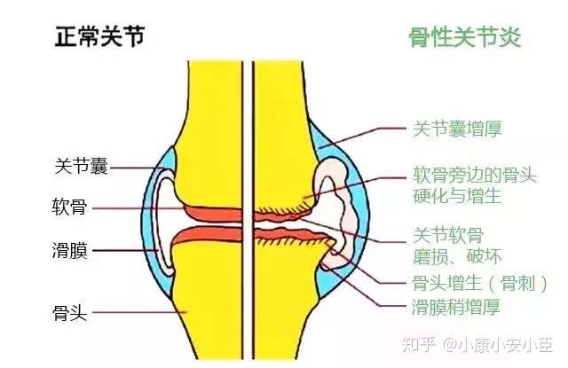 膝盖痛千万不能忍 一文搞定膝关节炎 知乎