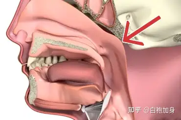 引领微创挑战禁区鼻咽癌能做手术切掉吗