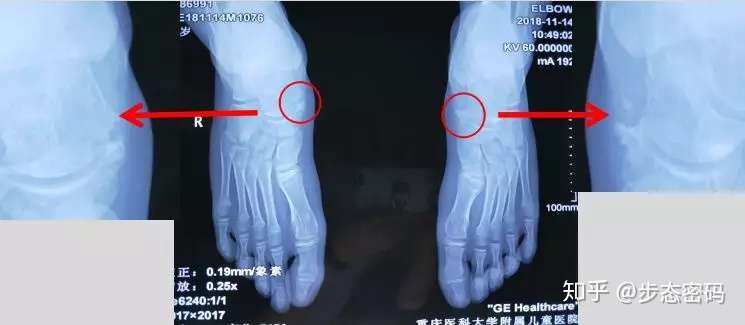 步态密码解析 十二 扁平足 副舟骨 知乎