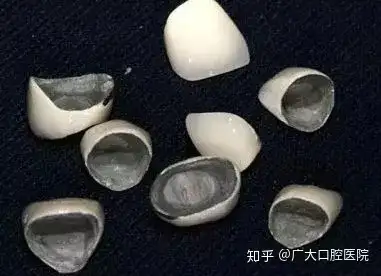 鎳鉻烤瓷牙屬於烤瓷牙中的非貴金屬烤瓷牙,是金屬烤瓷牙中最便宜的一