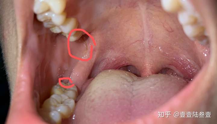 拔完智齿胶原蛋白线