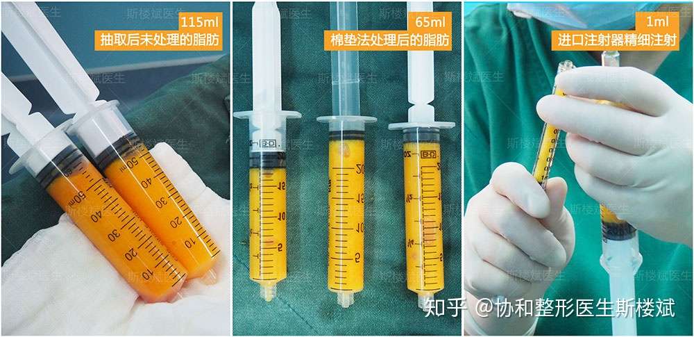 面部脂肪填充需要多少脂肪 手术中有什么要注意的地方 附案例 知乎