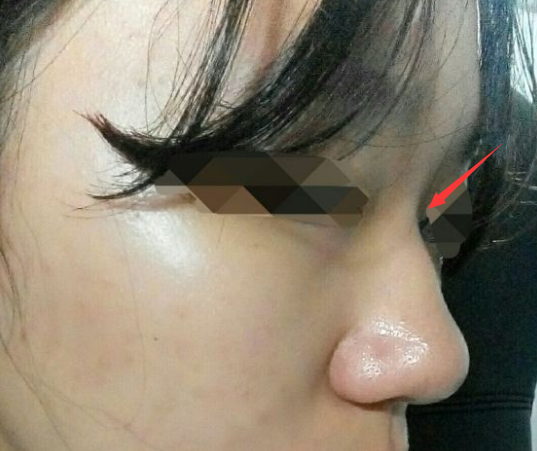 但是我觉得主要需要解决的问题是鼻头鼻翼的肥大.山根和鼻尖是其次.