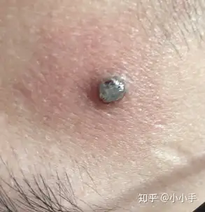 曲中周点痣药膏点痣记录