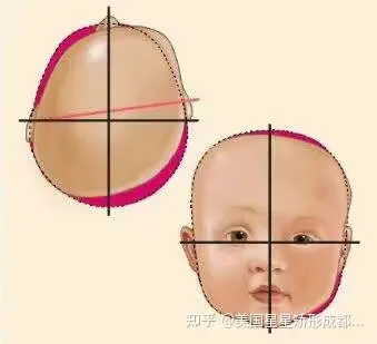 宝宝坐着,从头顶观察宝宝头骨,正常头型是椭圆形的,如果出现扁头综合