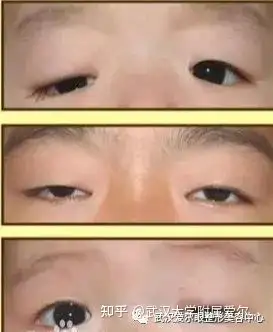 涨知识眼睑下垂赶紧看看这里