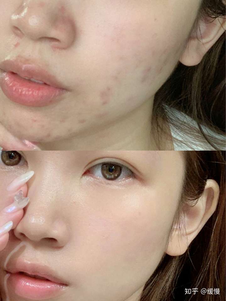 果酸手术管用么? - 知乎