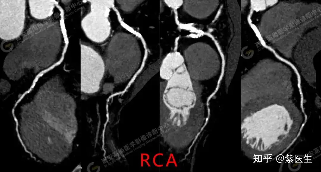 高尚医学影像之冠状动脉CT血流储备分数AI定量分析（CT-FFR） - 知乎