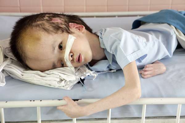 "橙剂"致畸,致癌是否为谎言?