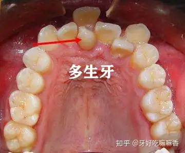 也是一种畸形牙,它们占领了正常牙齿的位置,导致正常的牙齿出现错位或