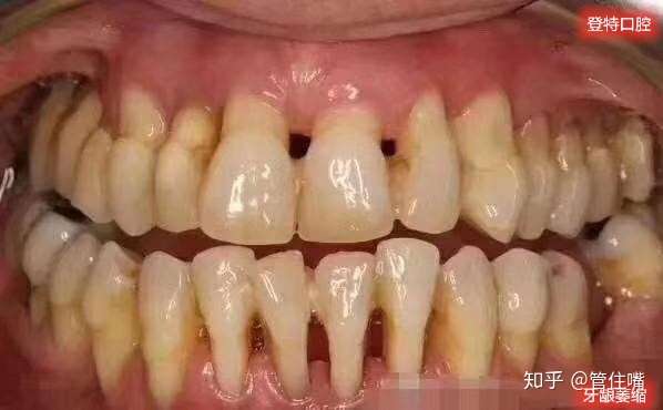 造成牙龈萎缩的原因有哪些