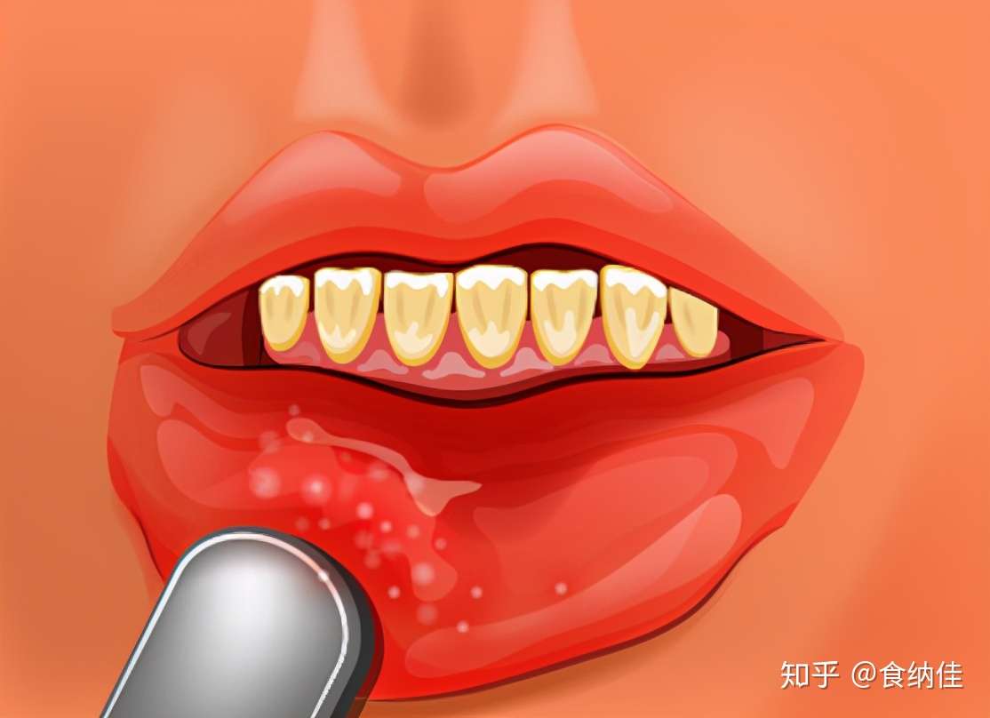 经常口腔溃疡 会不会得口腔癌 舌癌 专家做了这番解释 知乎